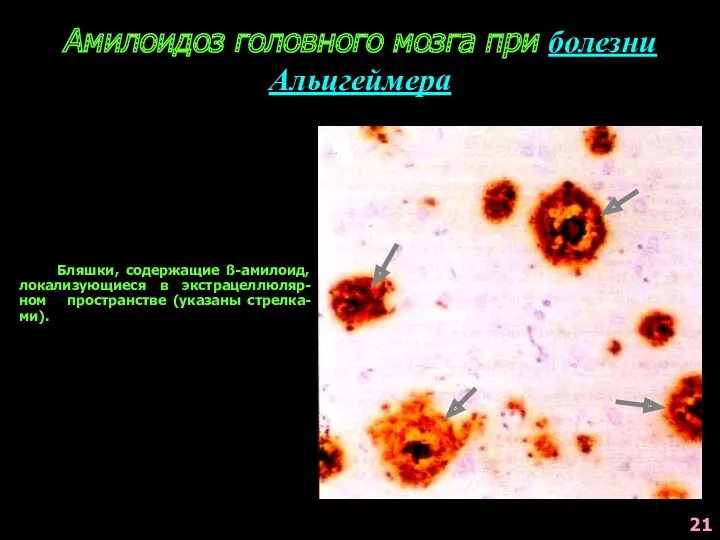 Бляшки, содержащие ß-амилоид, локализующиеся в экстрацеллюляр-ном пространстве (указаны стрелка-ми). Амилоидоз головного мозга при болезни Альцгеймера 21