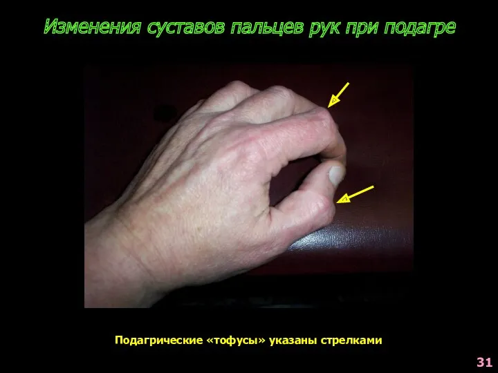 Изменения суставов пальцев рук при подагре Подагрические «тофусы» указаны стрелками 31