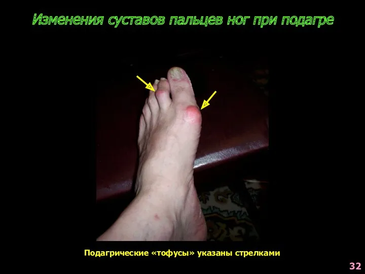 Изменения суставов пальцев ног при подагре Подагрические «тофусы» указаны стрелками 32