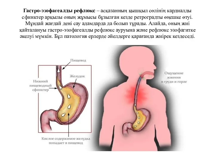 Гастро-эзофагеалды рефлюкс – асқазанның қышқыл сөлінің кардиалды сфинктер арқылы оның