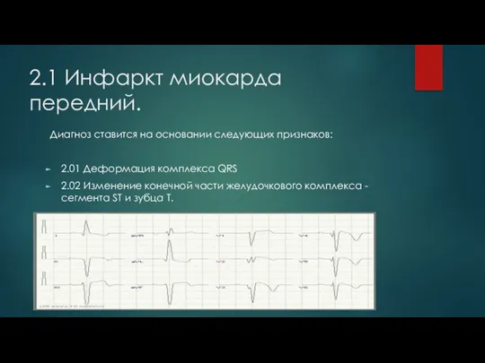 2.1 Инфаркт миокарда передний. Диагноз ставится на основании следующих признаков: