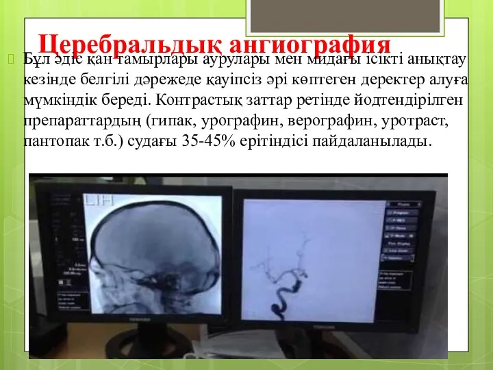 Церебральдық ангиография Бұл әдіс қан тамырлары аурулары мен мидағы ісікті