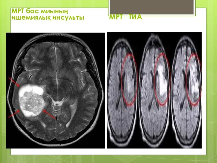 МРТ бас миының ишемиялық инсульты МРТ ТИА
