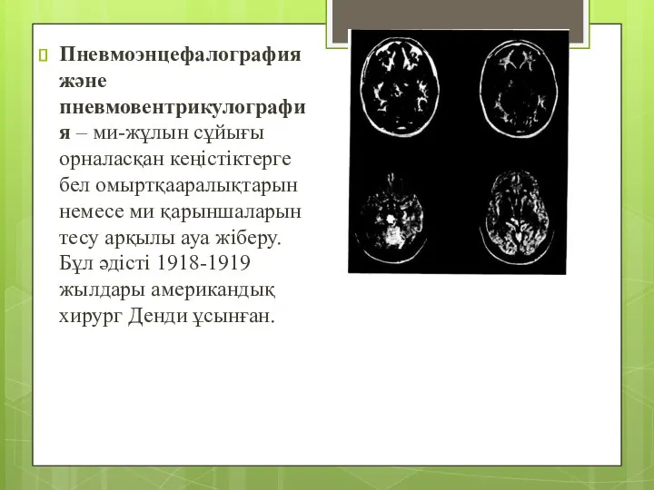 Пневмоэнцефалография және пневмовентрикулография – ми-жұлын сұйығы орналасқан кеңістіктерге бел омыртқааралықтарын