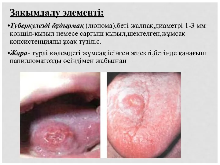 Зақымдалу элементі: Туберкулезді бұдырмақ (люпома),беті жалпақ,диаметрі 1-3 мм көкшіл-қызыл немесе