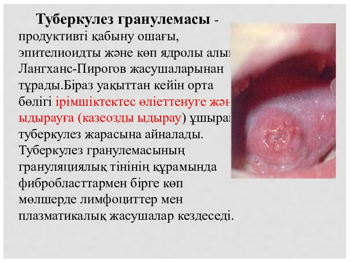 Туберкулез гранулемасы -продуктивті қабыну ошағы,эпителиоидты және көп ядролы алып Лангханс-Пирогов