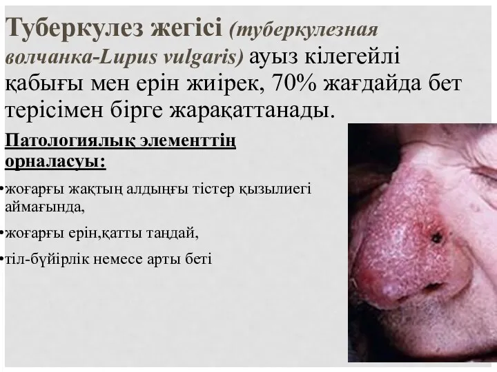 Туберкулез жегісі (туберкулезная волчанка-Lupus vulgaris) ауыз кілегейлі қабығы мен ерін