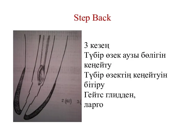 Step Back 3 кезең Түбір өзек аузы бөлігін кеңейту Түбір өзектің кеңейтуін бітіру Гейтс глидден, ларго