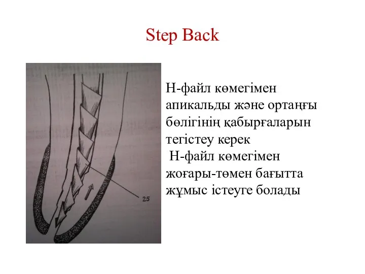 Step Back Н-файл көмегімен апикальды және ортаңғы бөлігінің қабырғаларын тегістеу