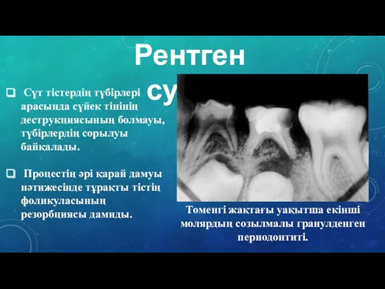 Рентген суреті Сүт тістердің түбірлері арасында сүйек тінінің деструкциясының болмауы,