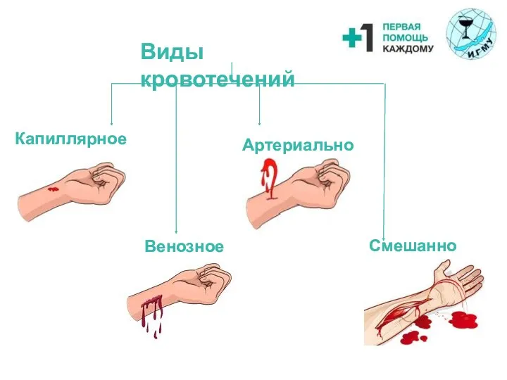 Виды кровотечений Капиллярное Венозное Артериальное Смешанное