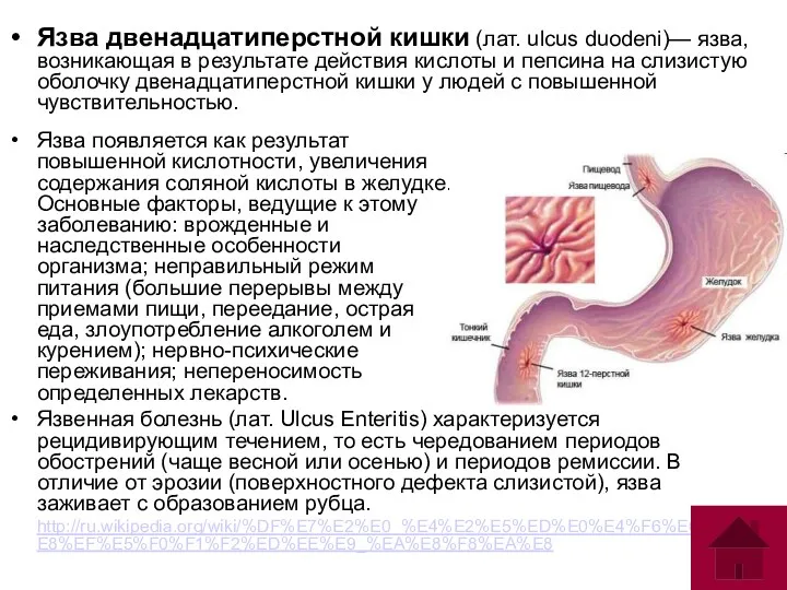 Язва двенадцатиперстной кишки (лат. ulcus duodeni)— язва, возникающая в результате