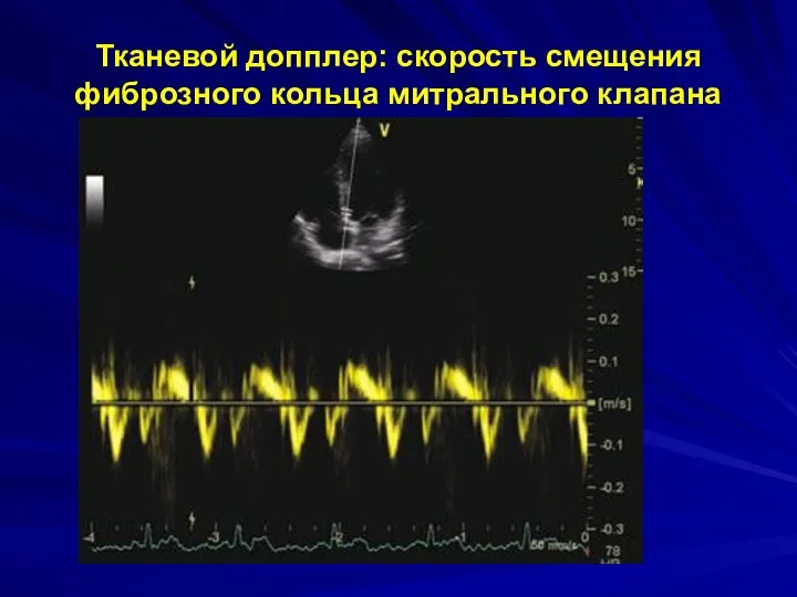 Тканевой допплер: скорость смещения фиброзного кольца митрального клапана