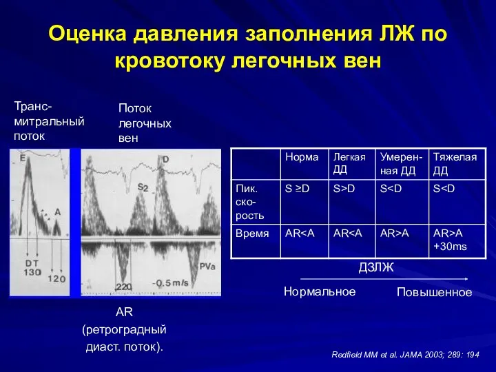 Оценка давления заполнения ЛЖ по кровотоку легочных вен Транс-митральный поток Поток легочных вен