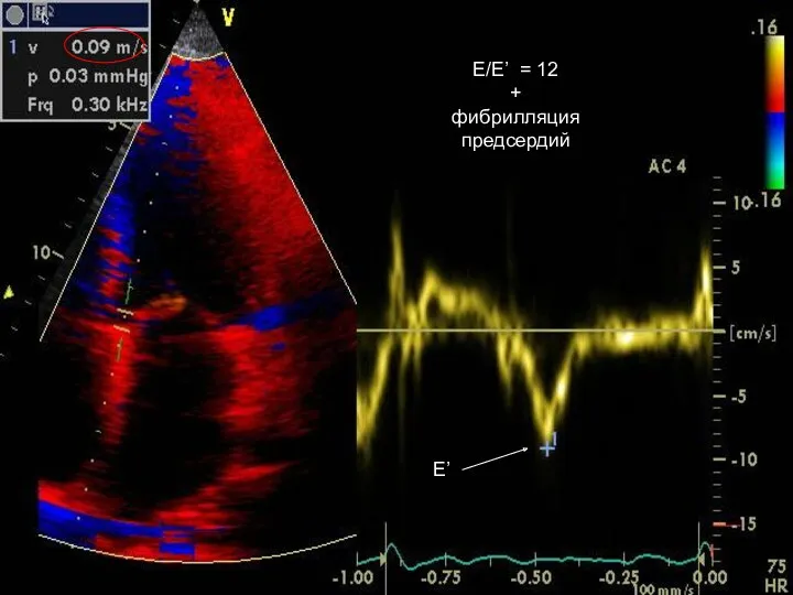 E’ E/E’ = 12 + фибрилляция предсердий