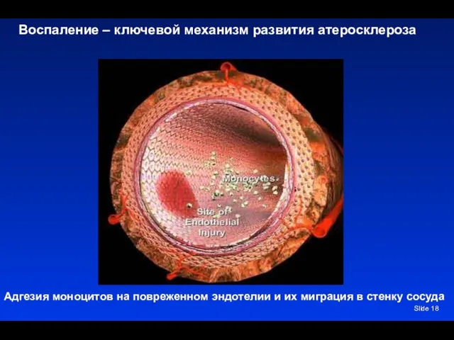 Slide Воспаление – ключевой механизм развития атеросклероза Адгезия моноцитов на