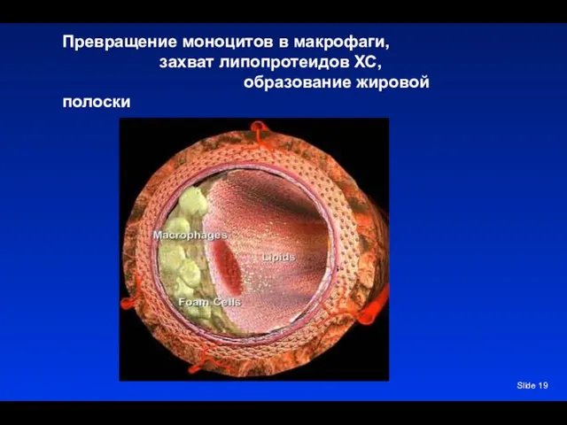 Slide Превращение моноцитов в макрофаги, захват липопротеидов ХС, образование жировой полоски