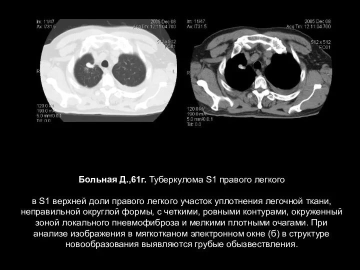 Больная Д.,61г. Туберкулома S1 правого легкого в S1 верхней доли