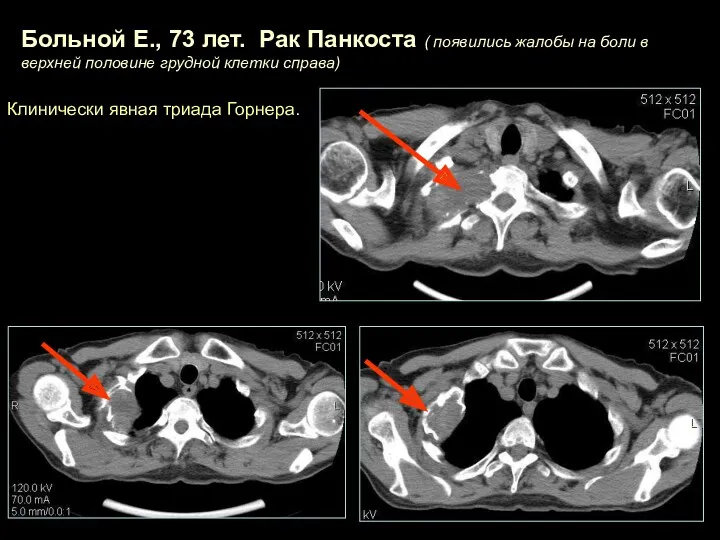 Больной Е., 73 лет. Рак Панкоста ( появились жалобы на