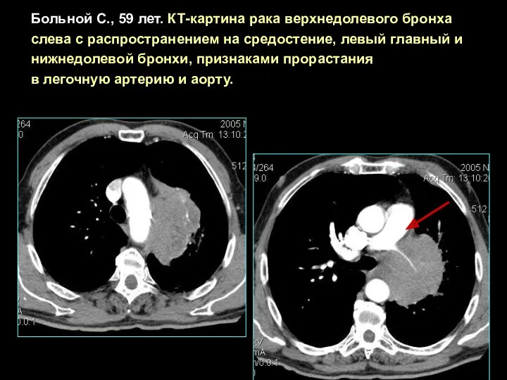 Больной С., 59 лет. КТ-картина рака верхнедолевого бронха слева с