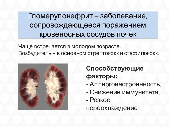 Гломерулонефрит – заболевание, сопровождающееся поражением кровеносных сосудов почек Чаще встречается