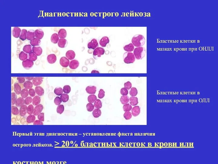 Диагностика острого лейкоза Первый этап диагностики – установление факта наличия