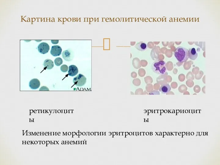 Картина крови при гемолитической анемии ретикулоциты эритрокариоциты Изменение морфологии эритроцитов характерно для некоторых анемий