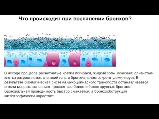 Что происходит при воспалении бронхов? В исходе процесса реснитчатые клетки