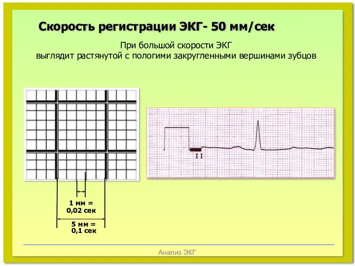 Анализ ЭКГ Скорость регистрации ЭКГ- 50 мм/сек При большой скорости