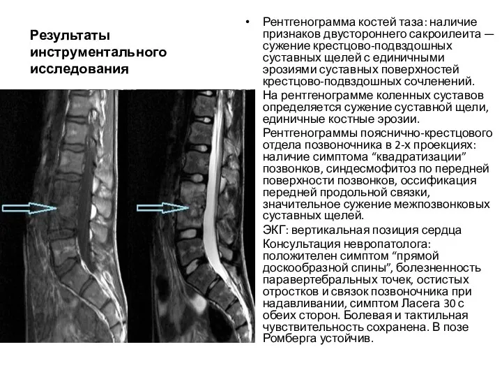 Результаты инструментального исследования Рентгенограмма костей таза: наличие признаков двустороннего сакроилеита