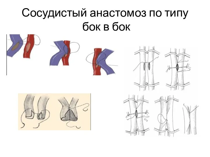 Сосудистый анастомоз по типу бок в бок