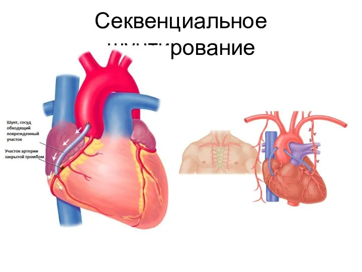 Секвенциальное шунтирование