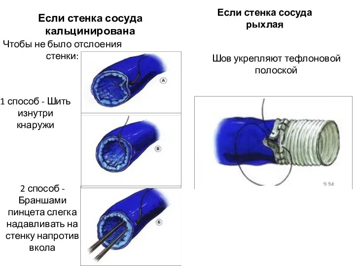 Если стенка сосуда кальцинирована Если стенка сосуда рыхлая Чтобы не