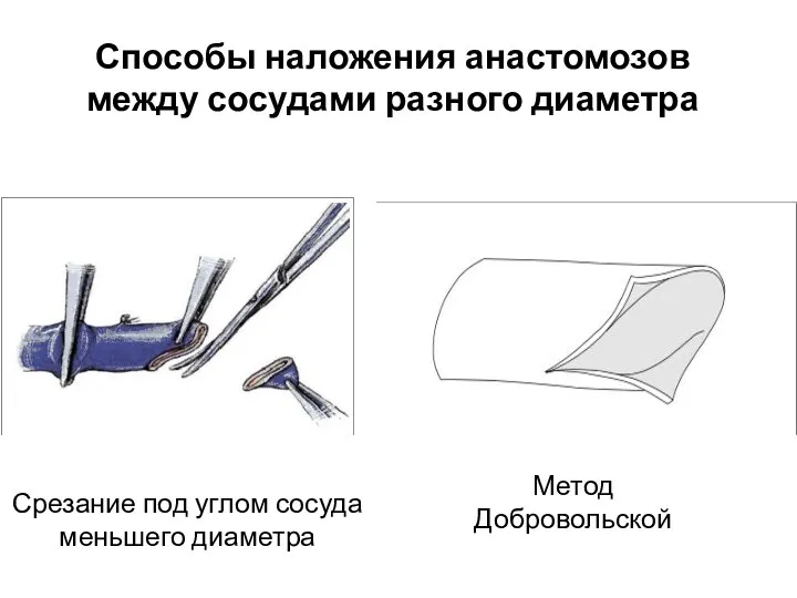 Способы наложения анастомозов между сосудами разного диаметра Срезание под углом сосуда меньшего диаметра Метод Добровольской