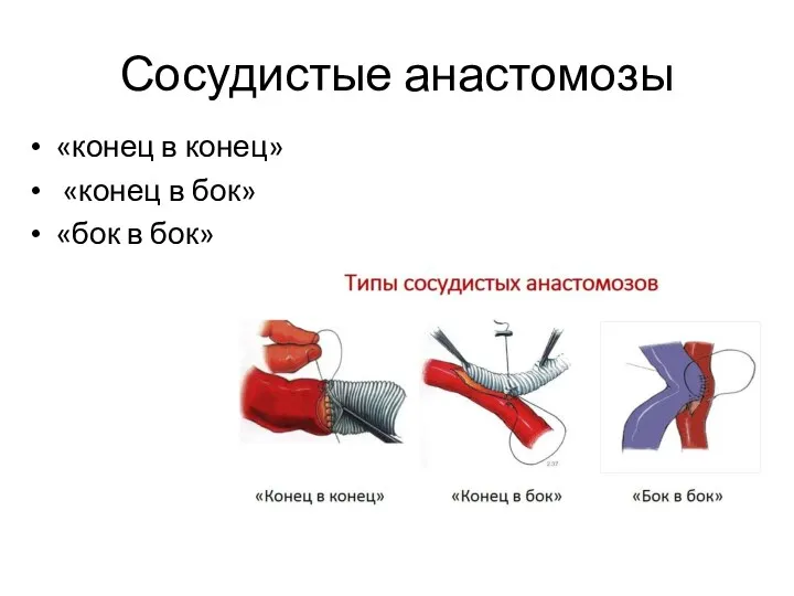 Сосудистые анастомозы «конец в конец» «конец в бок» «бок в бок»