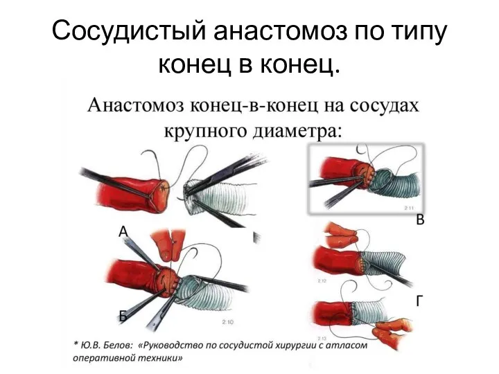 Сосудистый анастомоз по типу конец в конец.