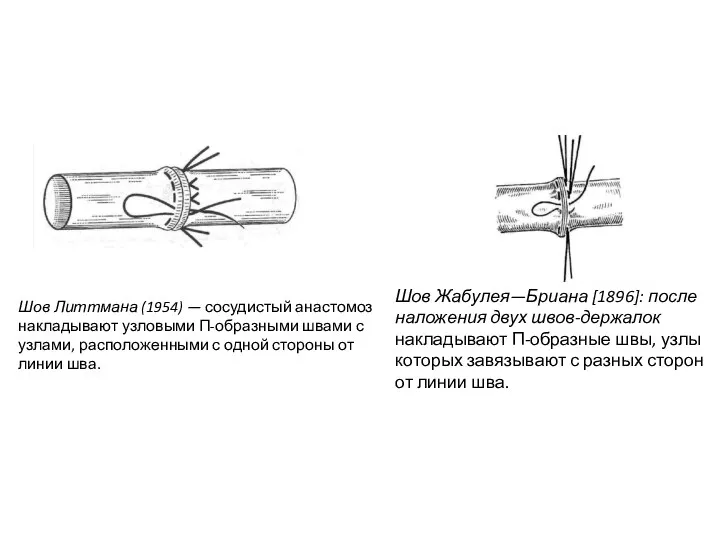 Шов Литтмана (1954) — сосудистый анастомоз накладывают узловыми П-образными швами с узлами, расположенными
