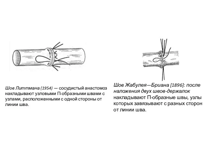 Шов Литтмана (1954) — сосудистый анастомоз накладывают узловыми П-образными швами