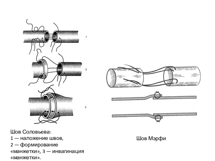 Шов Соловьева: 1 — наложение швов, 2 — формирование «манжетки», 3 — инвагинация «манжетки». Шов Мэрфи