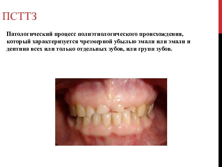 ПСТТЗ Патологический процесс полиэтиологического происхождения, который характеризуется чрезмерной убылью эмали