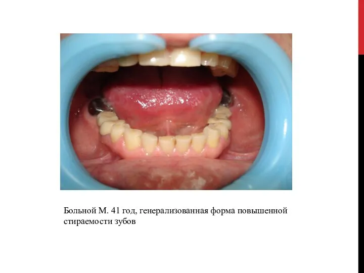 Больной М. 41 год, генерализованная форма повышенной стираемости зубов