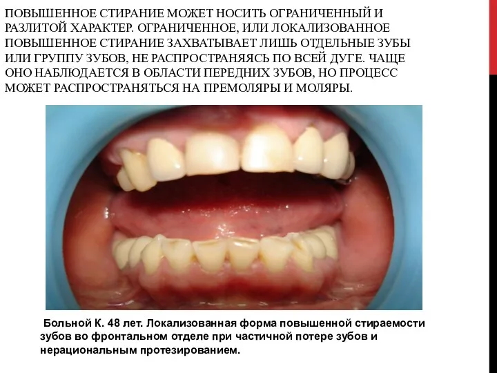 ПОВЫШЕННОЕ СТИРАНИЕ МОЖЕТ НОСИТЬ ОГРАНИЧЕННЫЙ И РАЗЛИТОЙ ХАРАКТЕР. ОГРАНИЧЕННОЕ, ИЛИ