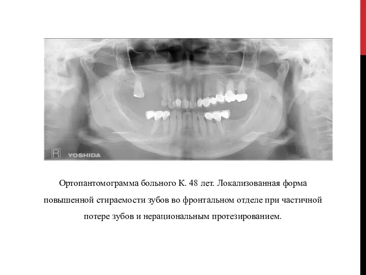 Ортопантомограмма больного К. 48 лет. Локализованная форма повышенной стираемости зубов