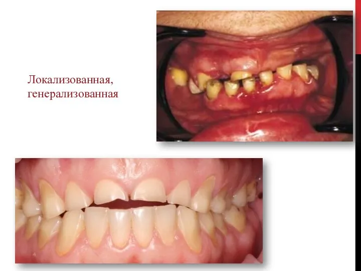 Локализованная, генерализованная