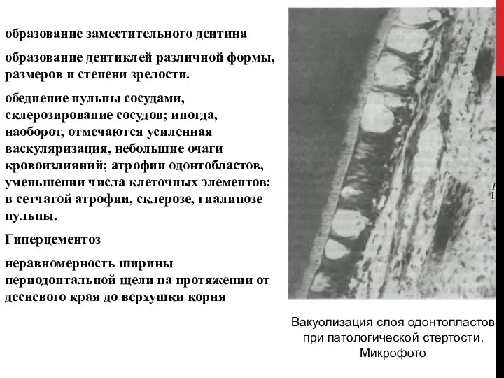 образование заместительного дентина образование дентиклей различной формы, размеров и степени