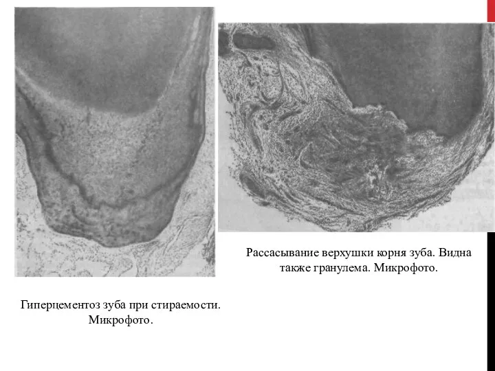 Рассасывание верхушки корня зуба. Видна также гранулема. Микрофото. Гиперцементоз зуба при стираемости. Микрофото.