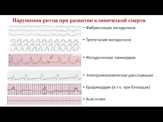 Нарушения ритма при развитии клинической смерти Фибрилляция желудочков Трепетание желудочков