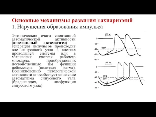 Основные механизмы развития тахиаритмий 1. Нарушения образования импульса Эктопические очаги