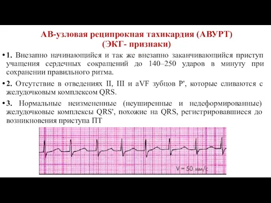 1. Внезапно начинающийся и так же внезапно заканчивающийся приступ учащения