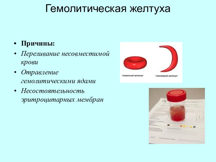 Гемолитическая желтуха Причины: Переливание несовместимой крови Отравление гемолитическими ядами Несостоятельность эритроцитарных мембран